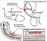 Induratio Penis Plastica